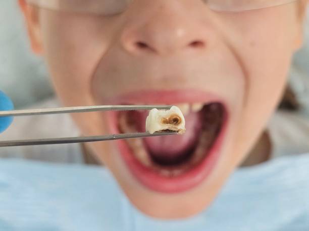 Best Emergency Root Canal Therapy in Saxon, SC